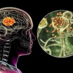 Brain-Infecting Fungus Reports Highlight the Importance of Reliable Health Information